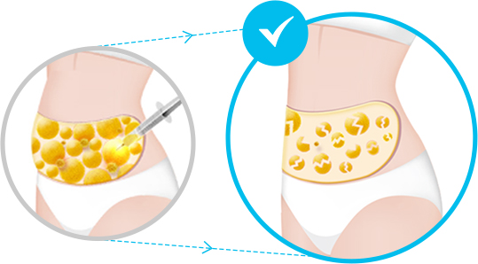 idブイロジックボディーPT注射で脂肪細胞が破壊される過程を説明するイメージ