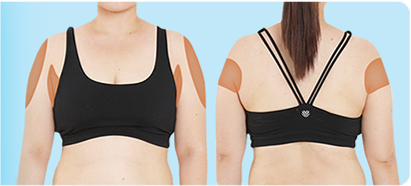 idブイロジックボディーPT注射でできるスリムなボディラインの種類イメージ