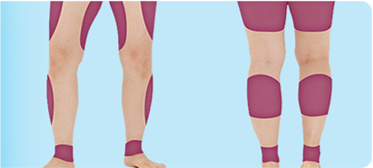 idブイロジックボディーPT注射でがっしりした脚、太ももが細くなった写真