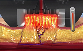 インモードFXモードが肌層に及ぼす影響を示す画像