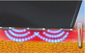 インモードFORMAモードが肌層に及ぼす影響を示す画像