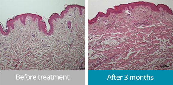 オンダリフティング施術前後写真 - コラーゲン生成促進による肌リフトアップ|弾力改善効果
