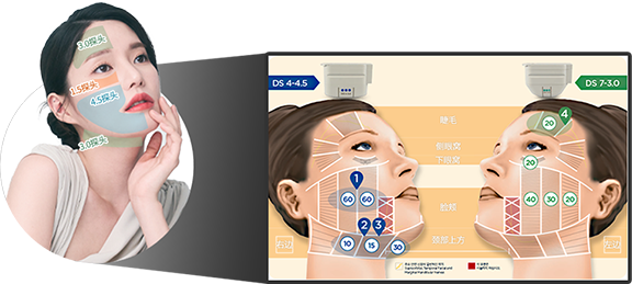 眉|側眼窩|眼窩下|頬|首上部など個人の顔形に合わせてデザイン可能な様々なウルセラチップの説明