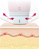 傾斜チップ構造で顔の部位ごとに正確なリフト施術を実現