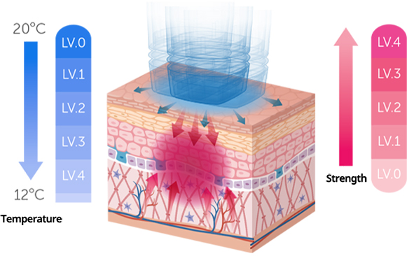 ハイドロクーリングとバイブレーションレベルで肌表面を保護し 回復期間が短いリフティング施術