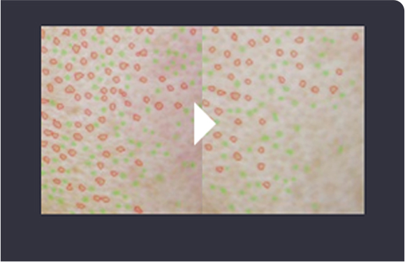 リジュランヒーラー施術4週間後の毛穴縮小比較写真