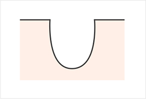 毛穴・傷跡のさまざまな形-アイスピック型 円盤型 ボックス型