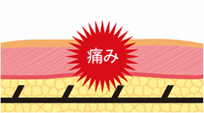 一般的なスレッドリフト後 糸の固定された突起が神経を刺激し痛みを引き起こす原理の説明